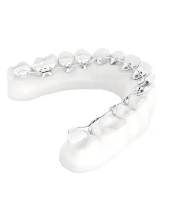 Unsichtbare Zahnspange, Lingualtechnik